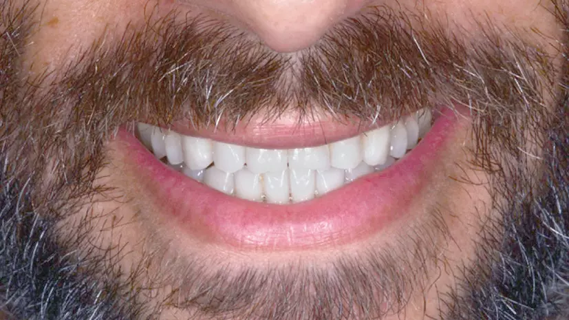 Abb. 13: Behandlungsphase 1 von 2: Lächeln nach Abschluss der Behandlung mit Invisalign®.
