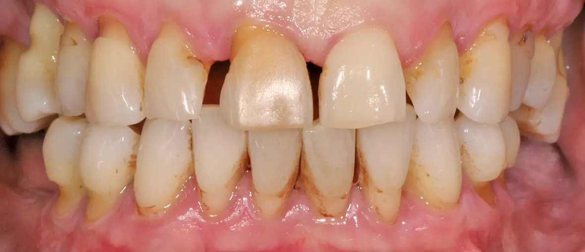 Abb. 13b: Ausgangsituation mit retrahierten Lippen.