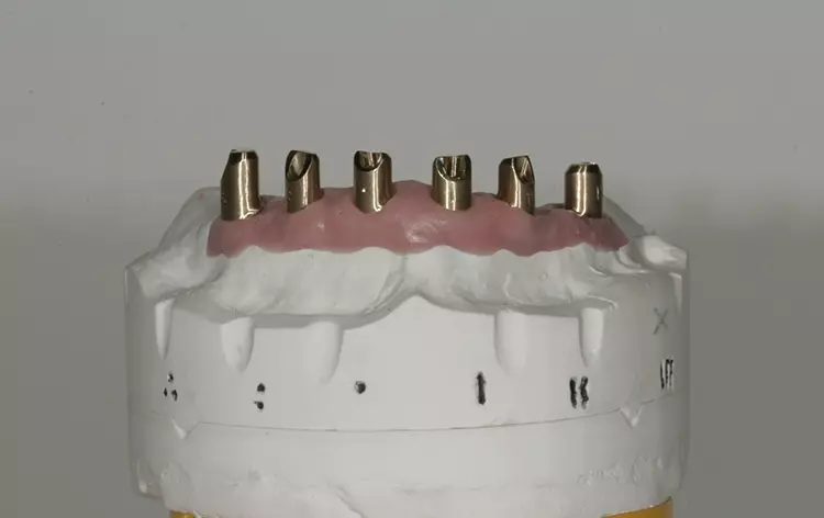 Abb. 142: Labial gegen Verwechslung gekennzeichnet.