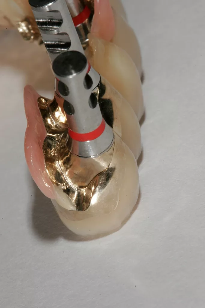 Abb. 144: … mit eingebrachtem Abutment eine perfekte Passung.
