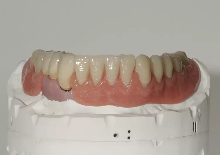 Abb. 145: Kronenrand 43 nur auf dem Modell freiliegend.