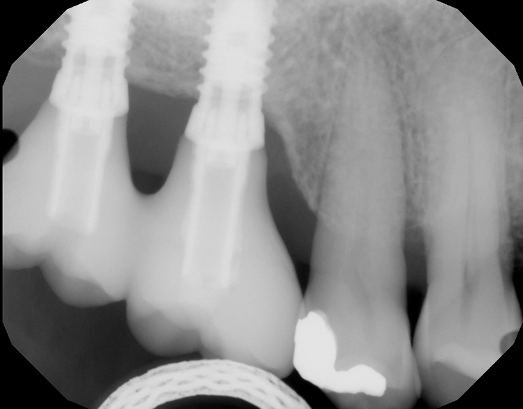 Abb. 17 und 18: Röntgenkontrollaufnahme der vollständig osseointegrierten Implantate
nach prothetischer Versorgung.