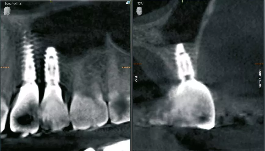 Abb. 14: Die radiologische Situation nach sechs Monaten (Implantatposition 25).