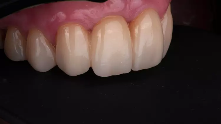 Abb. 14: Stabiles und ästhetisch ansprechendes Behandlungsergebnis.