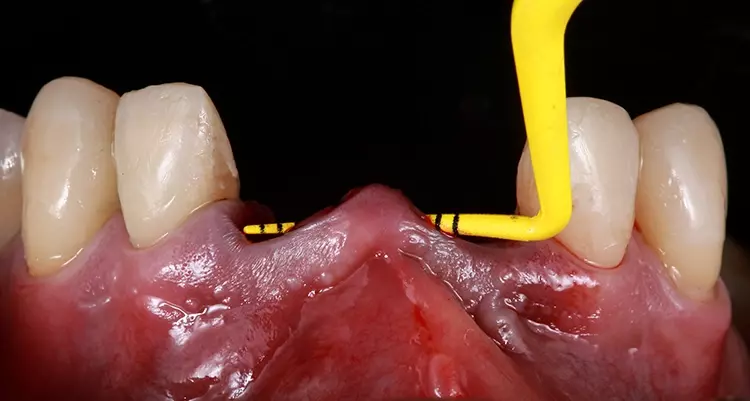 Abb. 14: Die Integrität der Interdentalpapillen konnte dank der Tunneltechnik
erhalten werden.