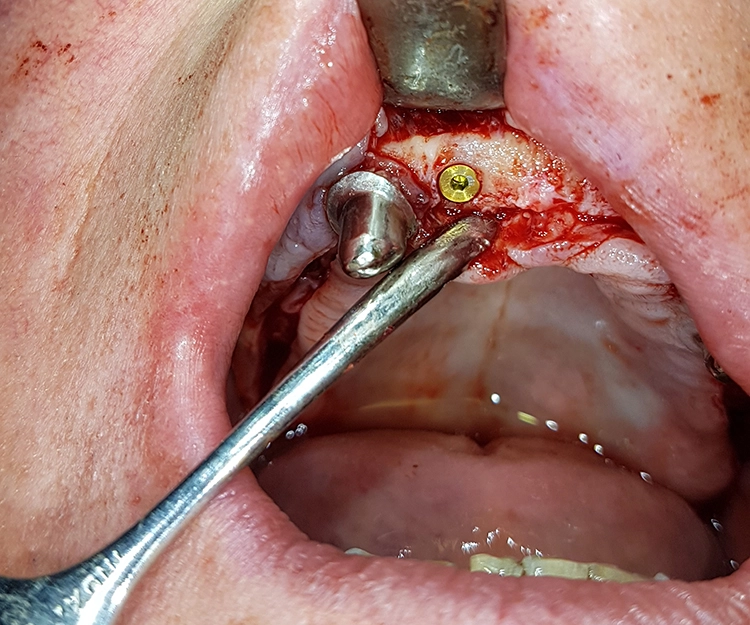 Abb. 14: Darstellung der Implantatsitus in regiones 17, 15 bis 14, 12, 22 und 25 bis 27 mit knöchernen Defekten im bukkalen und frontalen Bereich.
