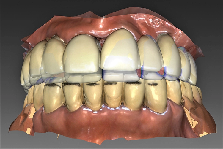 Abb. 14: Dentales Prototyping durch Matching der Daten des 1. Prototypen mit den realen Bissverhältnissen des Patienten, gefolgt vom virtuellen Zweitvorschlag. Als Hilfslinie für die Konstruktion wurde eine Markierung an den realen Zähnen in den Scan einbezogen.