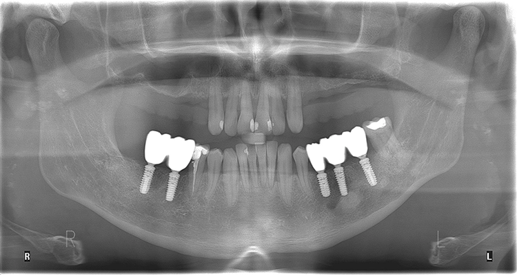 Abb. 14: Finale Versorgung wie geplant mit von Knochen überlagerter Implantatschulter und den BioHPP-Kronenabutments.