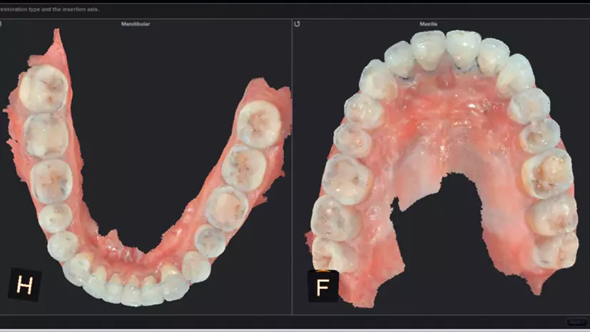 Abb. 14: Anfertigung eines intraoralen Scans beider Zahnbögen (CS 3600, Carestream®).