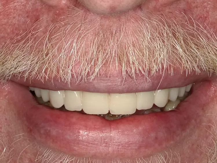 Abb. 12: Neue Ästhetik: Patient mit definitiver Versorgung mit einer festsitzenden
Brücke.