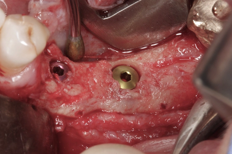 Abb. 14: Die Insertion von zwei Implantaten im Unterkiefer links.