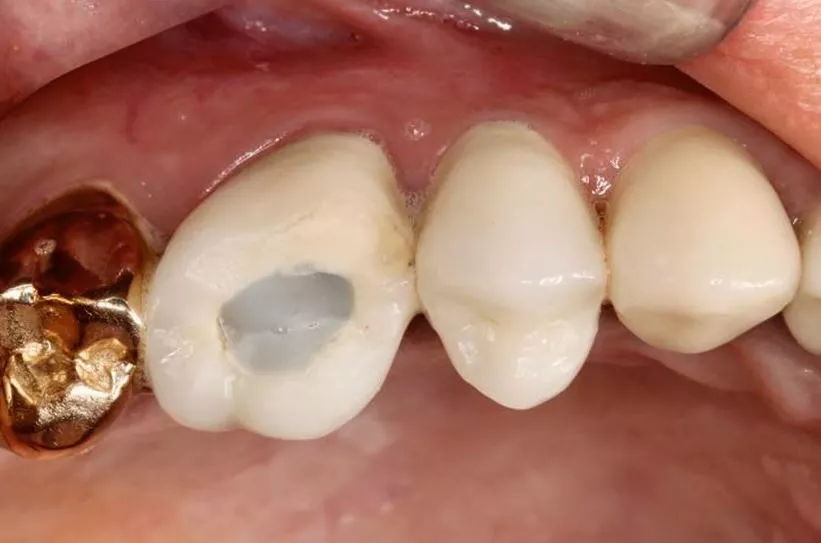 Abb. 14a: CEREC MTL Zirkonoxidkronen und -brücken lassen sich mit konventionellen oder selbstadhäsiven Zementen befestigen.