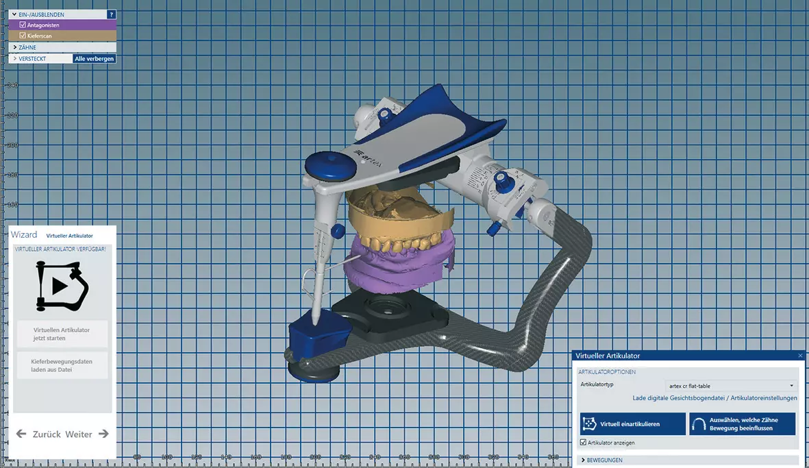 Abb. 14a: Die digital abgeformte Ausgangssituation im virtuellen Artikulator.