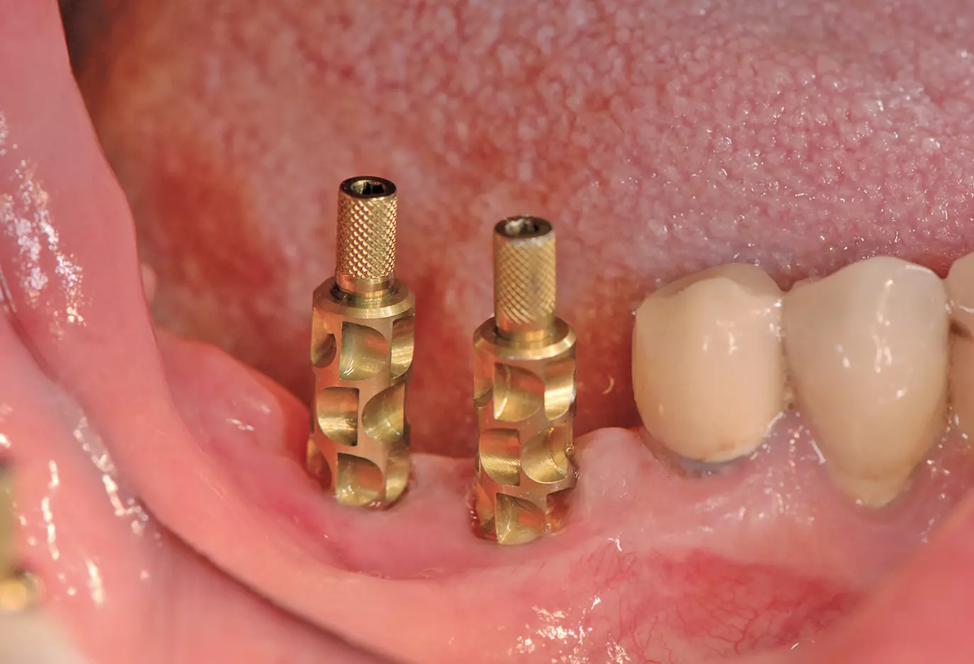 Abb. 14b: Aufgeschraubte Abformpfosten.