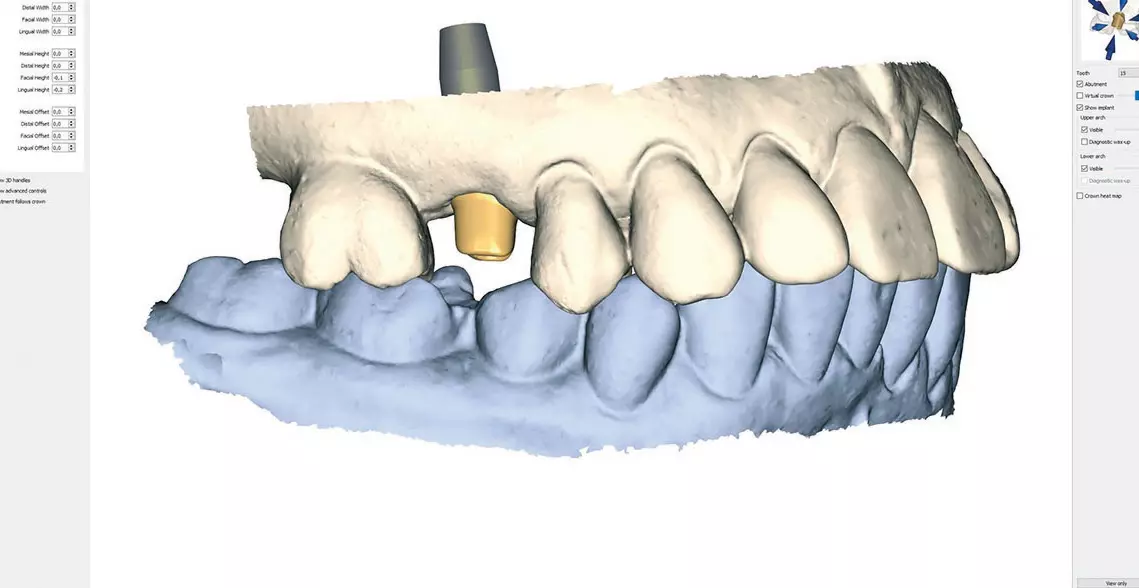 Abb. 14b: Konstruktion des patientenindividuellen Abutments orientierend am Wax-up (Atlantis-WebOrder).