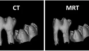 Die Studie zeigt, dass es keine signifikanten Unterschiede zwischen Aufnahmen der Magnetresonanztomographie (MRT) ohne Röntgenstrahlung und der Computertomographie (CT) gibt.