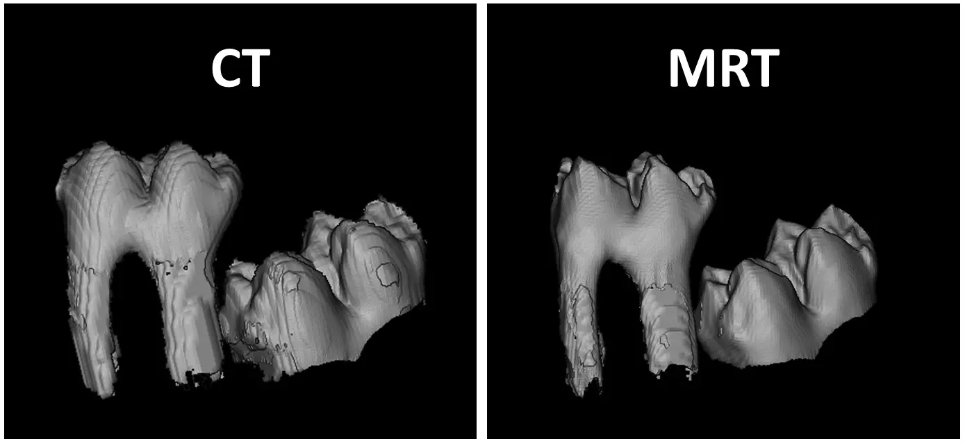 Die Studie zeigt, dass es keine signifikanten Unterschiede zwischen Aufnahmen der Magnetresonanztomographie (MRT) ohne Röntgenstrahlung und der Computertomographie (CT) gibt.