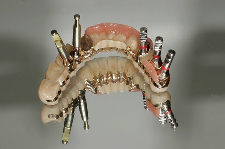Abb. 150: Mit Abutments werden die Divergenzen deutlich.