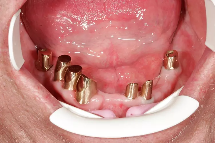 Abb. 150: Perfekter Sitz der Primärteleskope und Abutments.
