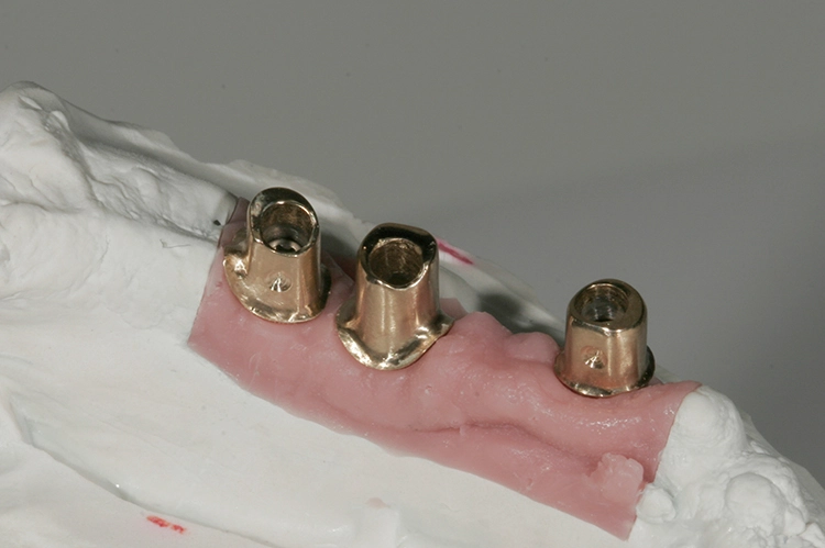Abb. 151: Abutments 3. Quadrant von lingual.