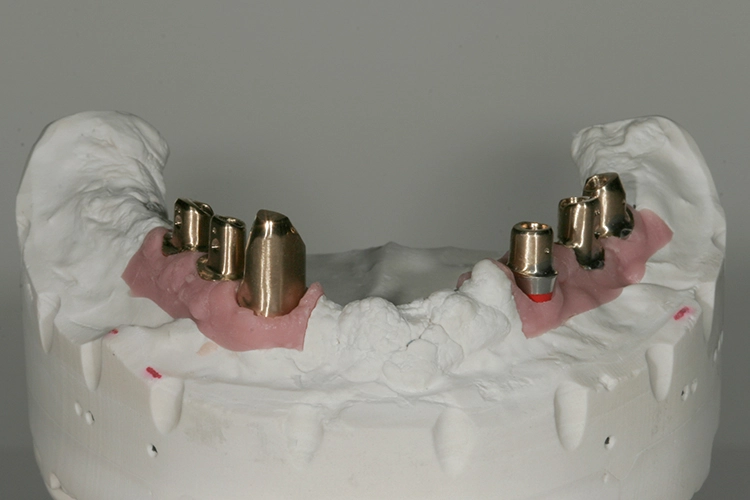 Abb. 153: Sämtliche Abutments.