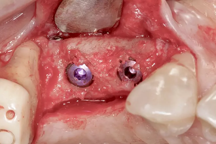 Abb. 15: Der gut revaskularsierte Knochen im Oberkiefer rechts und die Insertion
von 2 Implantaten