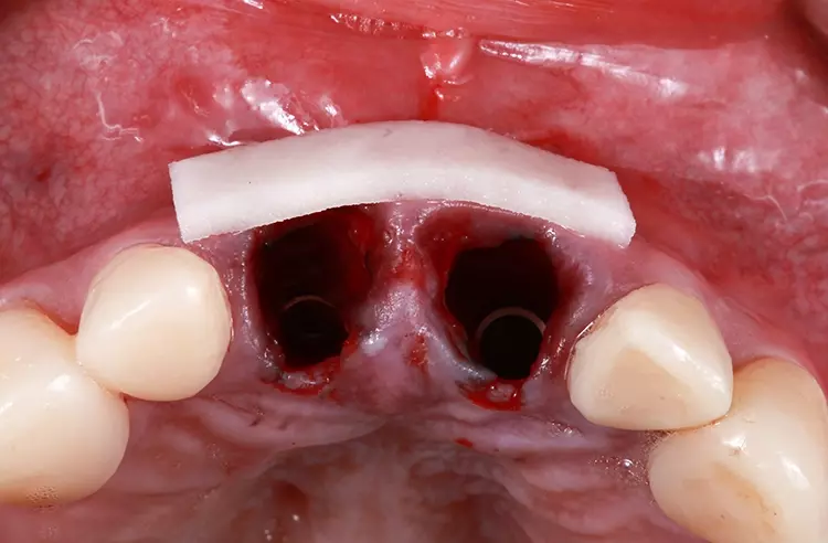 Abb. 15: Kollagenmatrix als Gingivaersatzmaterial vor Insertion.