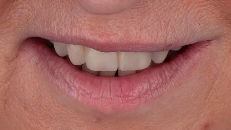 Abb. 15: Stabiles und ästhetisch ansprechendes Behandlungsergebnis.