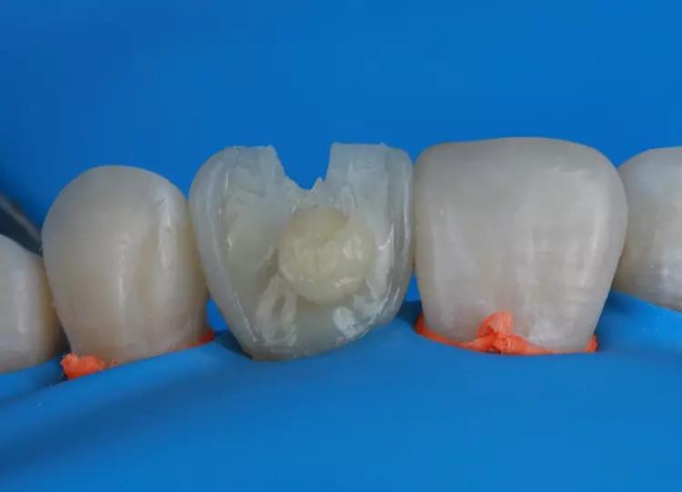 Abb. 15: Schichtung des Komposit-Veneers. Nach Farbanalyse beginnt die Schichtung hauptsächlich
im zervikalen Bereich.
