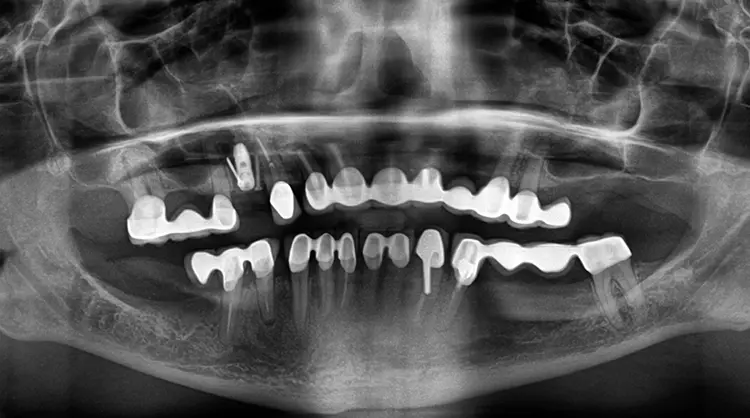 Abb. 14: Das postoperative Röntgenbild zeigt den augmentierten Bereich im 1. Quadranten.
Das Implantat konnte dank der Hangar-Technik simultan inseriert werden.