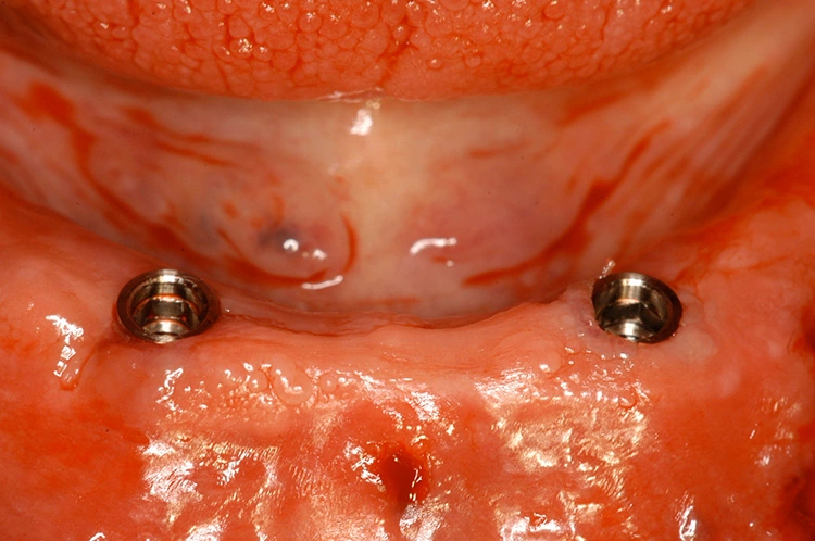 Abb. 15: Implantate nach Abnahme der Schablone.