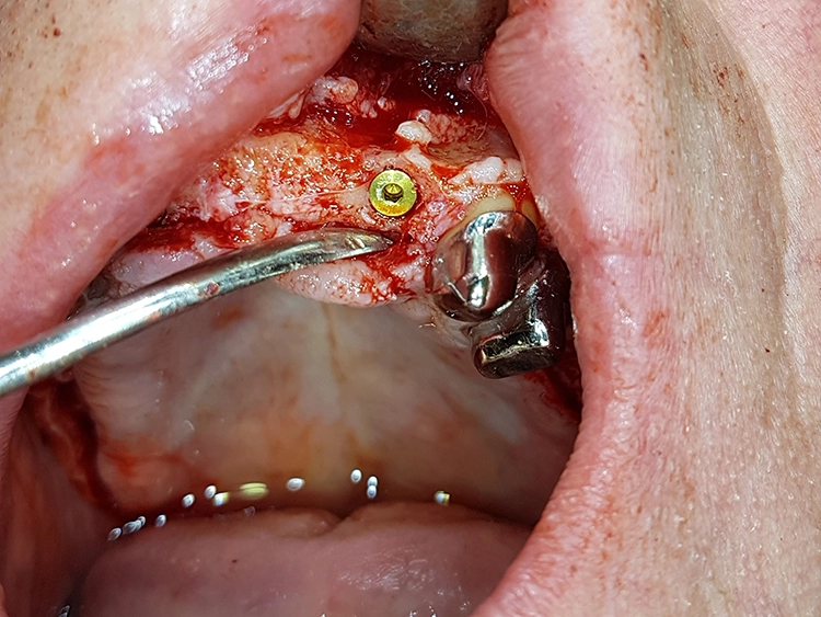 Abb. 15: Darstellung der Implantatsitus in regiones 17, 15 bis 14, 12, 22 und 25 bis 27 mit knöchernen Defekten im bukkalen und frontalen Bereich.