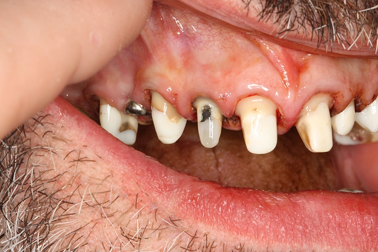Abb. 15 bis 18: I. bis IV. Quadrant mit präparierten Pfeilern und Gingivaformern über den Implantaten.