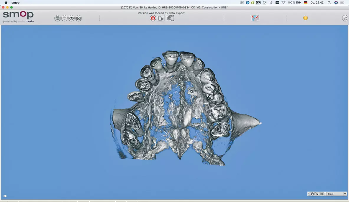 Abb. 15a: Die Implantatplanung mit eingelesenem DVT.