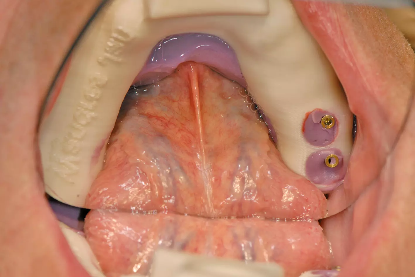 Abb. 15a: Abformung mit individuellem Abformlöffel als Grundlage für das Meistermodell und das Herstellen der patientenindividuellen CAD/CAM-Abutments.