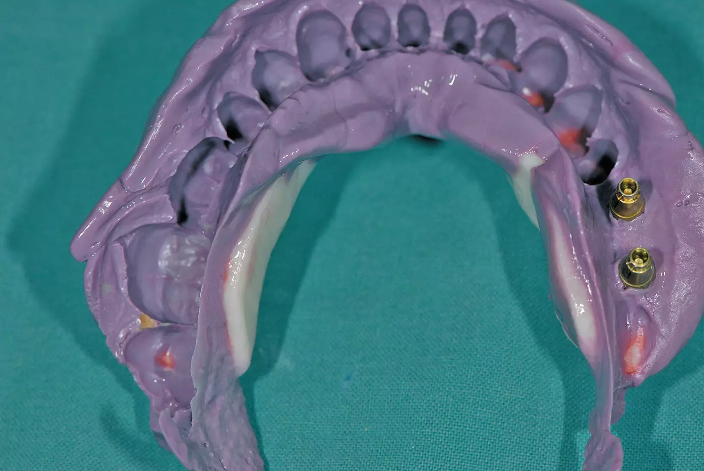 Abb. 15b: Abformung mit individuellem Abformlöffel als Grundlage für das Meistermodell und das Herstellen der patientenindividuellen CAD/CAM-Abutments.