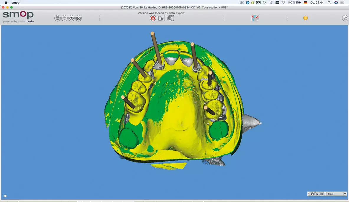 Abb. 15d: Planung der Implantatposition hier mit Ausrichtung der Mesostruktur.