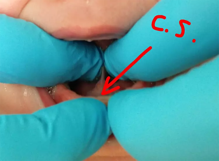 Abb. 16: Anheben der beiden zu schonenden C. sublingualis.