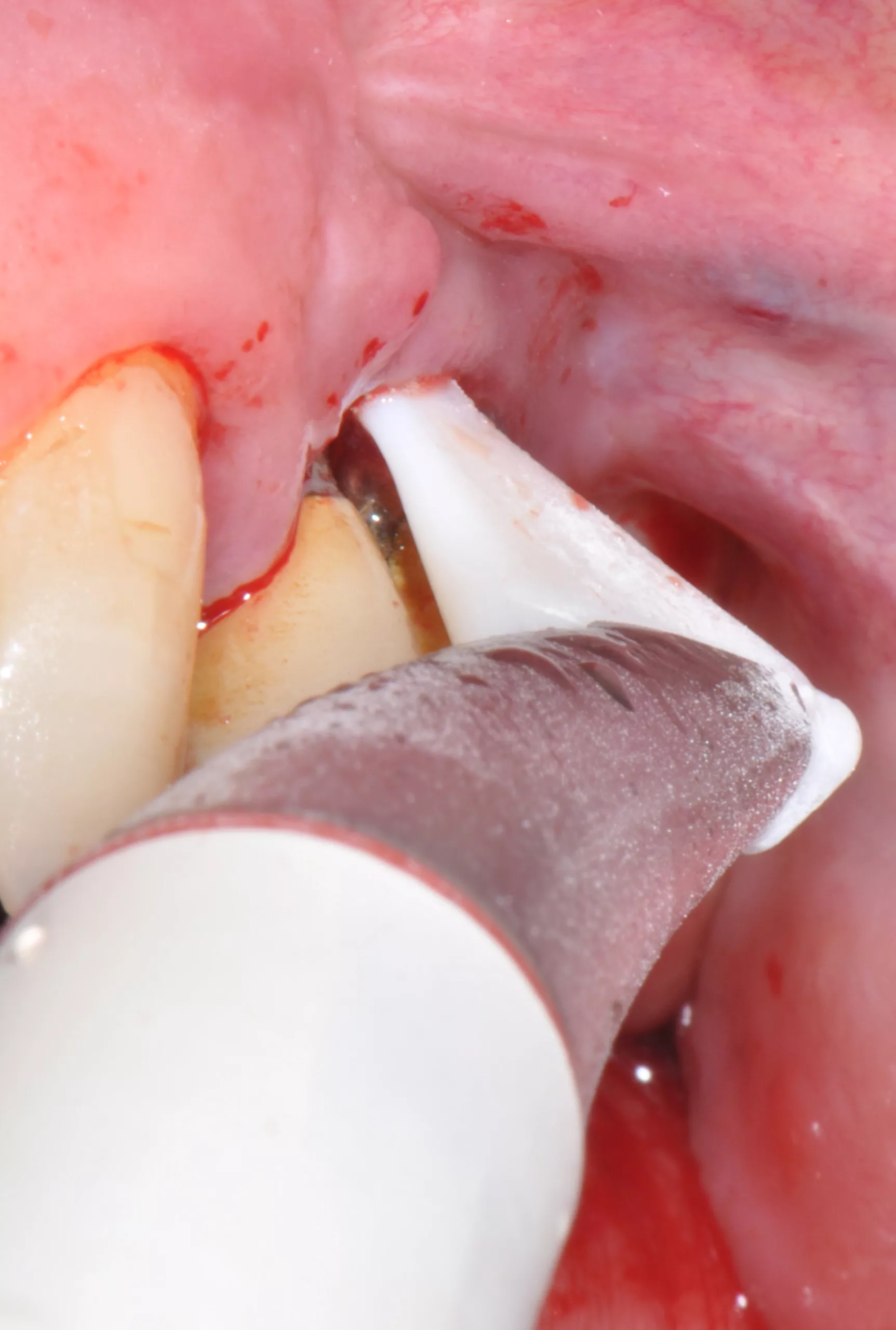 Abb. 16: Subgingivale Dekontamination mit Erythritolpulver und subgingivaler Spitze.