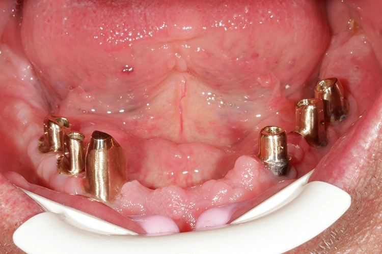 Abb. 164: Sämtliche Abutments eingegliedert.