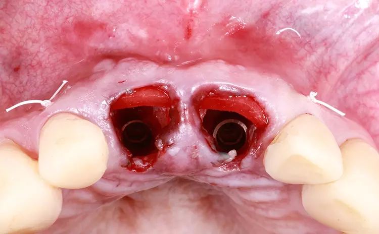 Abb. 16: Gingivaersatzmaterial in der endgültigen Position, imprägniert und
infiltiriert mit Blut und mit dem Weichgewebe vernäht.