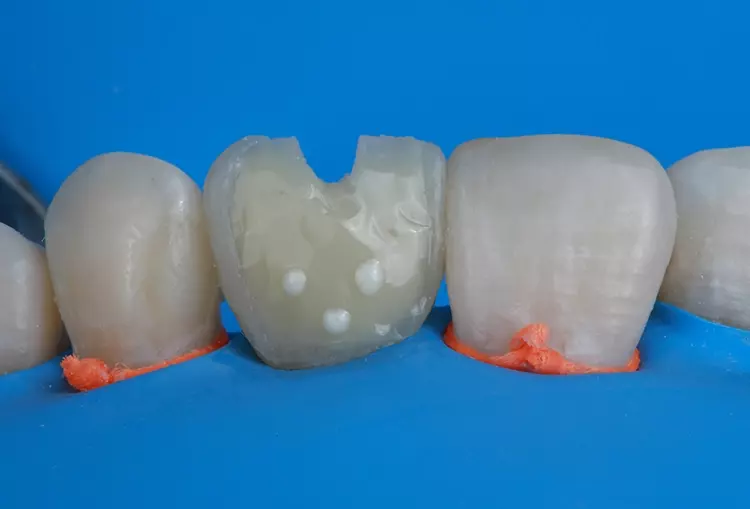 Abb. 16: Schichtung des Komposit-Veneers. Nach Farbanalyse beginnt die Schichtung hauptsächlich
im zervikalen Bereich.