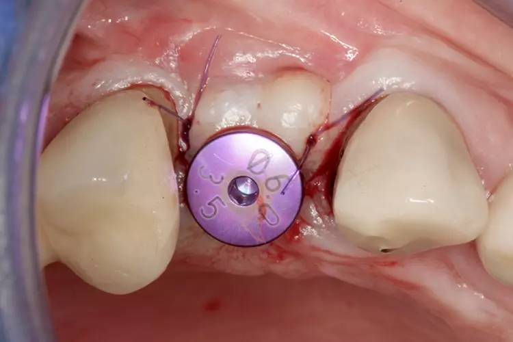 Abb. 15: Es erfolgen die Freilegung mittels einfacher Verdrängungsinzision und
das Aufbringen des Gingivaformers.