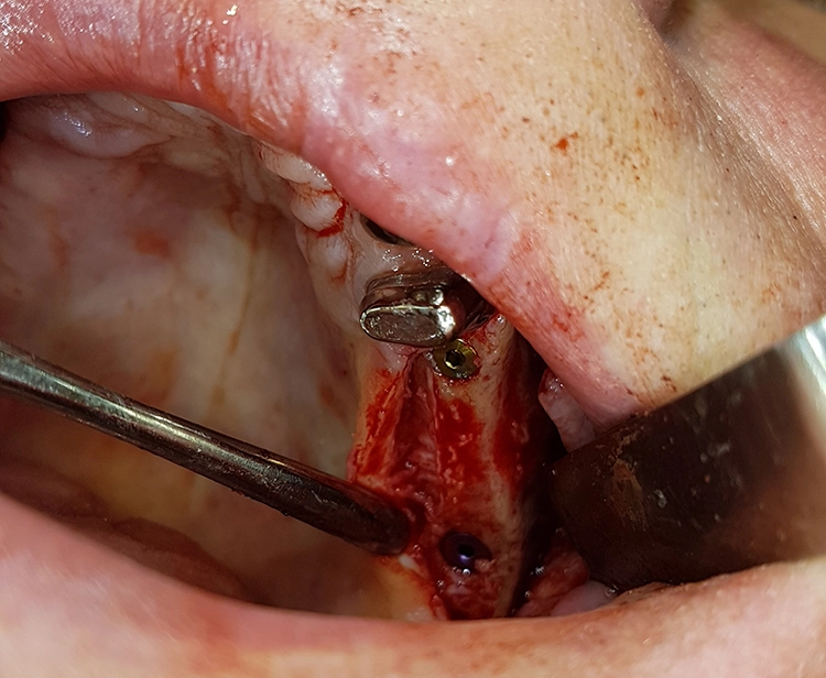 Abb. 16: Darstellung der Implantatsitus in regiones 17, 15 bis 14, 12, 22 und 25 bis 27 mit knöchernen Defekten im bukkalen und frontalen Bereich.