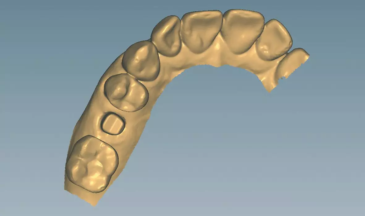 Abb. 16a: Importierte Core-File-Datei des Abutments in der Laborsoftware: Konstruktion der monolithischen Implantatkrone mit vestibulärer Verblendung.