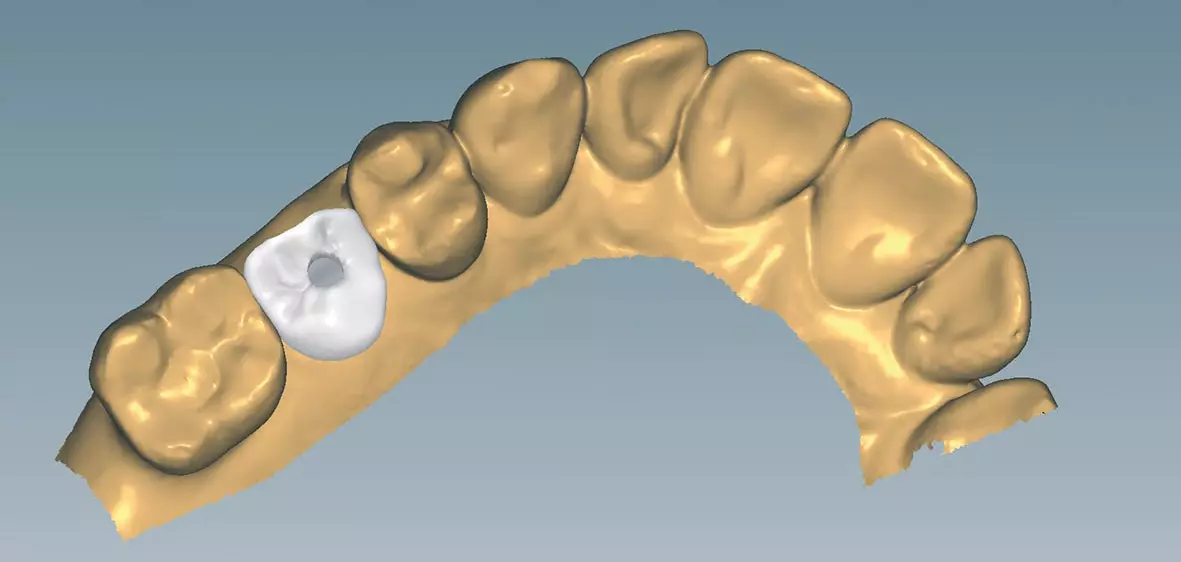 Abb. 16b: Importierte Core-File-Datei des Abutments in der Laborsoftware: Konstruktion der monolithischen Implantatkrone mit vestibulärer Verblendung.