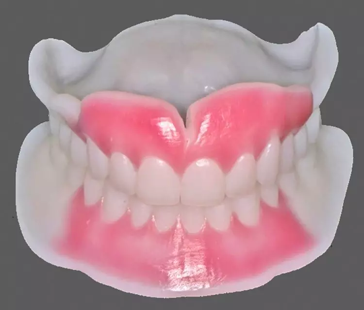 Abb. 17: Monoblock-Einprobe gefräst aus ProArt CAD Try in (Ivoclar). Für die
Einprobe wurde die Gingiva von Prämolar zu Prämolar mit rosafarbigem Wachs
gecovered.