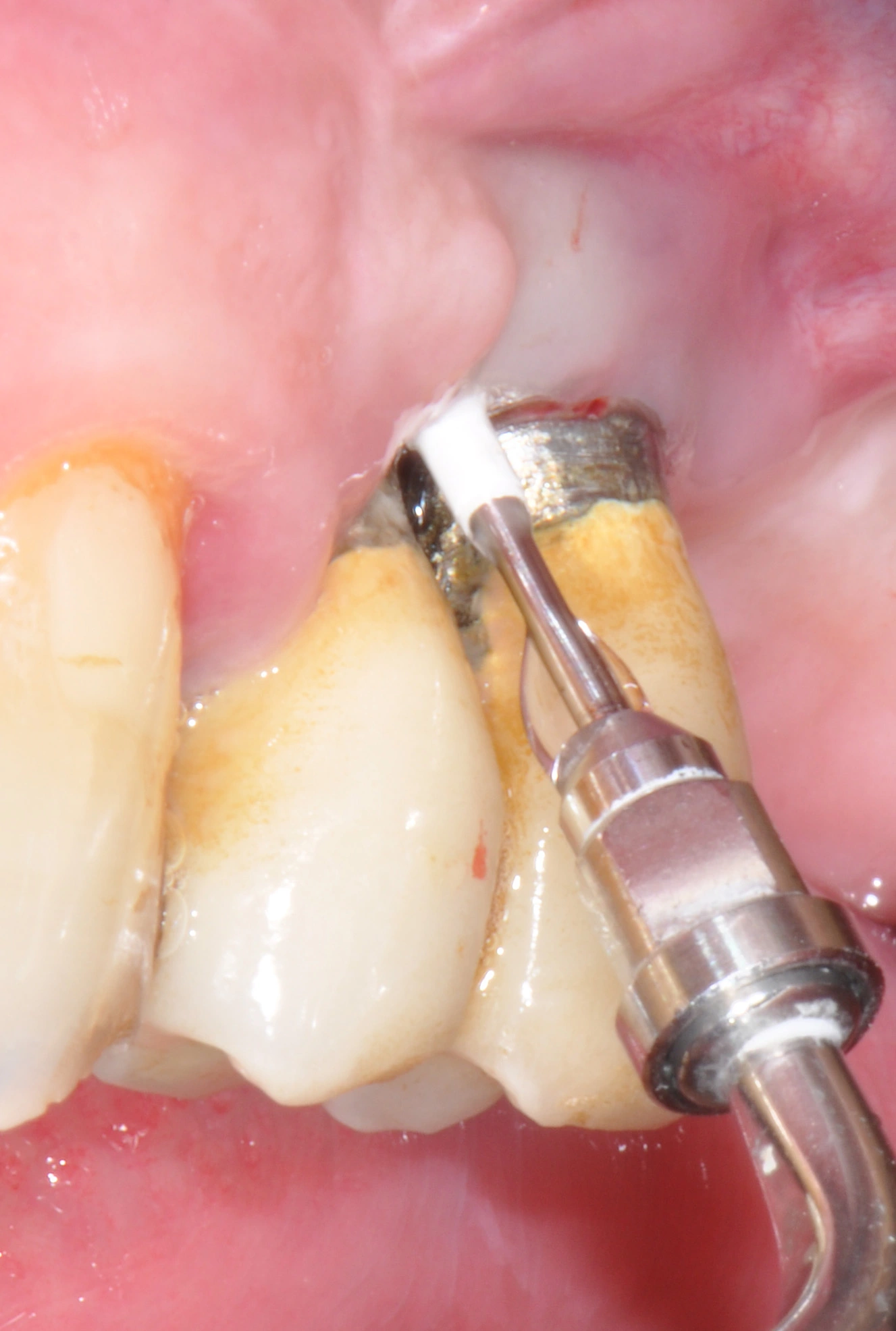 Abb. 17: Débridement der Implantatoberfläche mit Ultraschallgeräten und PEEK-Spitze.