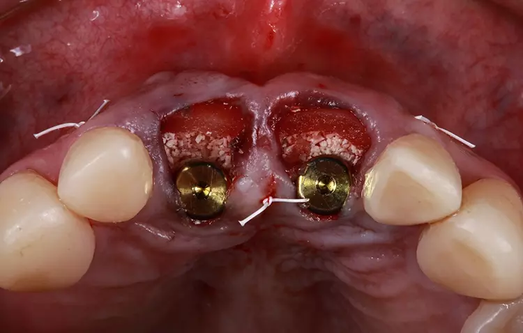 Abb. 17: Knochen- und Kollagenvolumen in Relation zu den Implantaten nach
Einbringen des Knochenersatzmaterials.