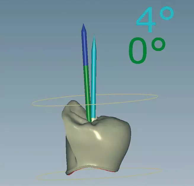 Abb. 17: CAM-Datensatz der Implantatkrone mit Darstellung des Schraubkanals.